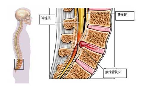 下肢疼痛、麻木是腰椎管狭窄？
