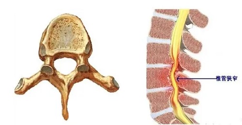 腰椎管狭窄形成的原因都有哪些？