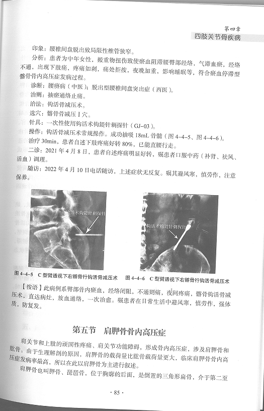 中华钩活术钩活骨减压术（四肢关节骨疾病第五节）