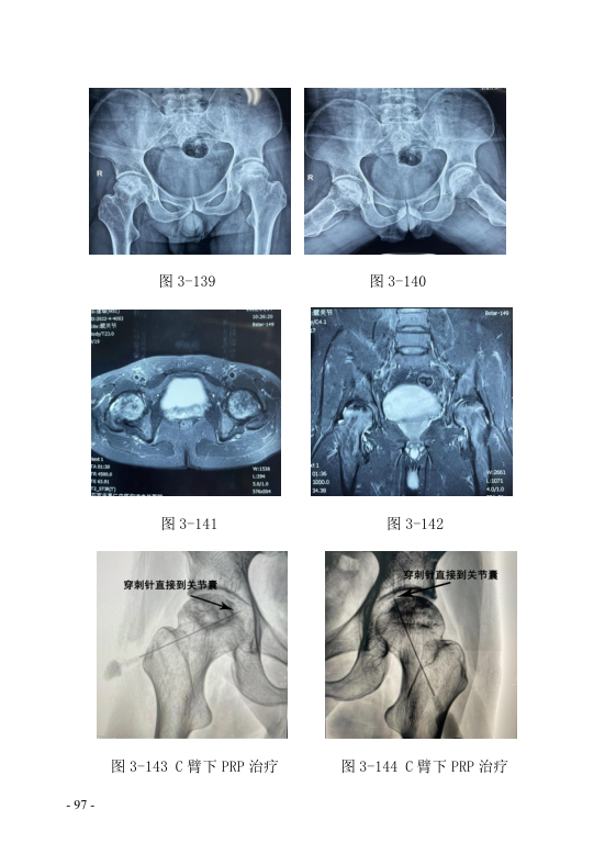 中医钩活术技术(自出）转出第108页.jpg